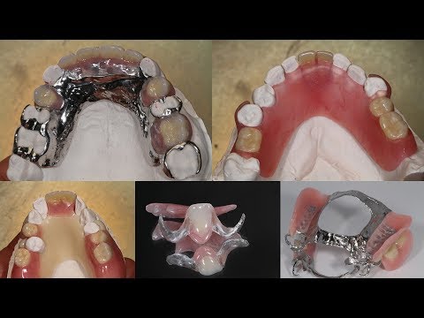 Video: Types Of Dental Prosthetics