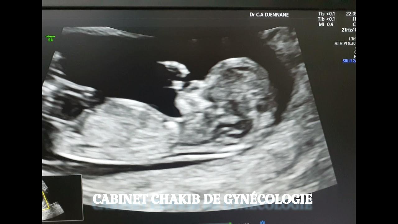 Coupe LCC , Clarté nucale. YouTube