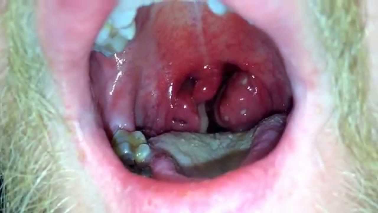 Very sore throat. - YouTube