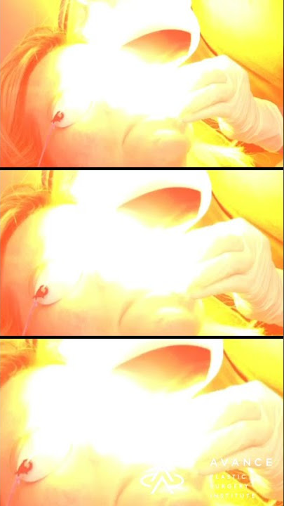 Intense Pulsed Light (Lumecca IPL)