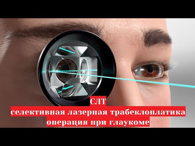 СЛТ - селективная лазерная 💥💥💥 трабекулопластика в лечении глаукомы 👀