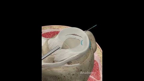 Meniscus Bucket Handle Tear Repair