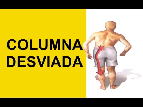 Hernia Discal Causa Columna Desviada (Nervio Ciatico Pinchado) 