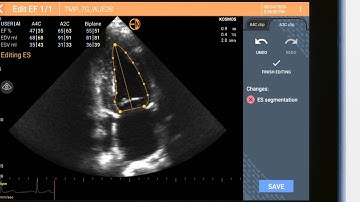 Reviewing AI Left Ventricle Tracing | Kosmos Ultrasound Systems