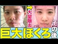 【大公開】巨大ホクロをぶっこぬいたスタッフのその後の肌は!?