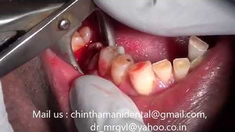 Painless extraction of molar rootstumps and immediate implants in India  video part 1