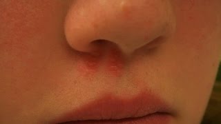 видео Болячка в носу не проходит: чем лечить?