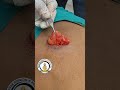 Lipoma Excision