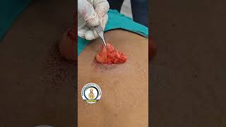 Lipoma Excision