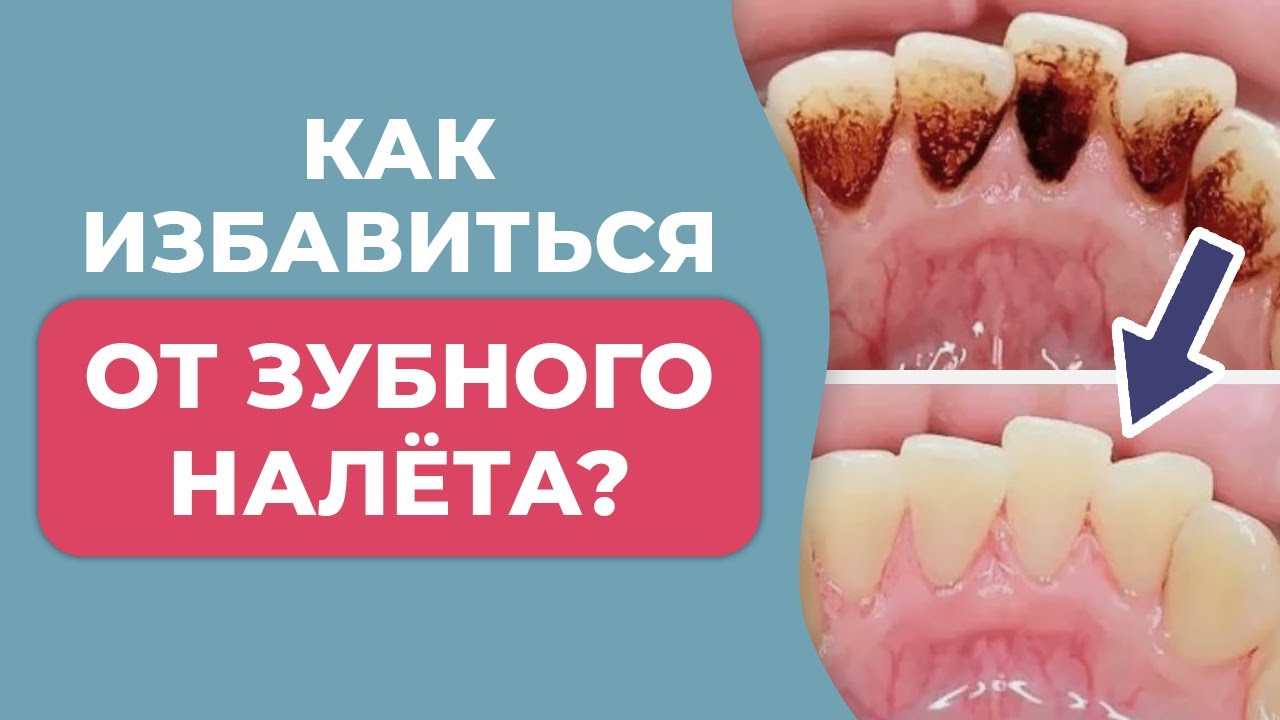 Зубной камень и зубной налет / Причины появления и как избавиться?