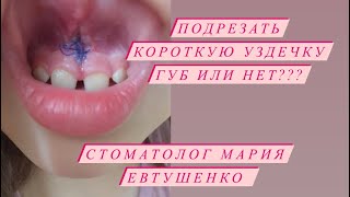 видео: Нужно ли подрезать уздечки губ? Совет стоматолога Марии Евтушенко. Москва картинка: Нужно ли подрезать уздечки губ? Совет стоматолога Марии Евтушенко. Москва
