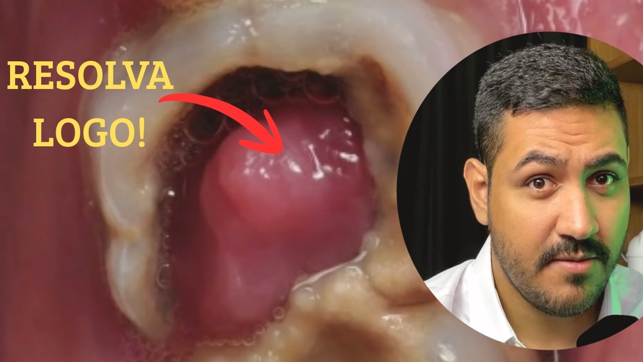 Carne cresceu dentro do dente? Descubra o que é o pólipo pulpar e como ...