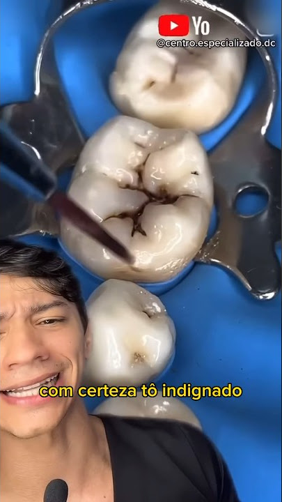 “Esse Dentista é Doido, Escondeu a Cárie dentro do dente?!” Veja até o Final…#shorts