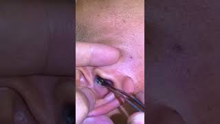 Ear Cleaning #318