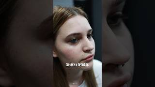 Носослезная борозда, устранение провалов и синяков под глазами #носослезнаяборозда