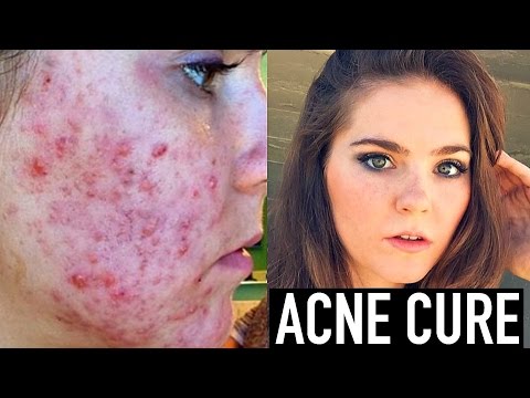 CURING ACNE + Acne Scar Treatment