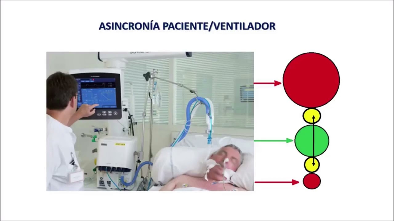 INTERPRETACIÓN DE LAS ASINCRONÍAS VENTILATORIAS A LA CABECERA DEL PACIENTE CRÍTICO.