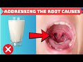 TONSIL STONES Addressing the ROOT CAUSES
