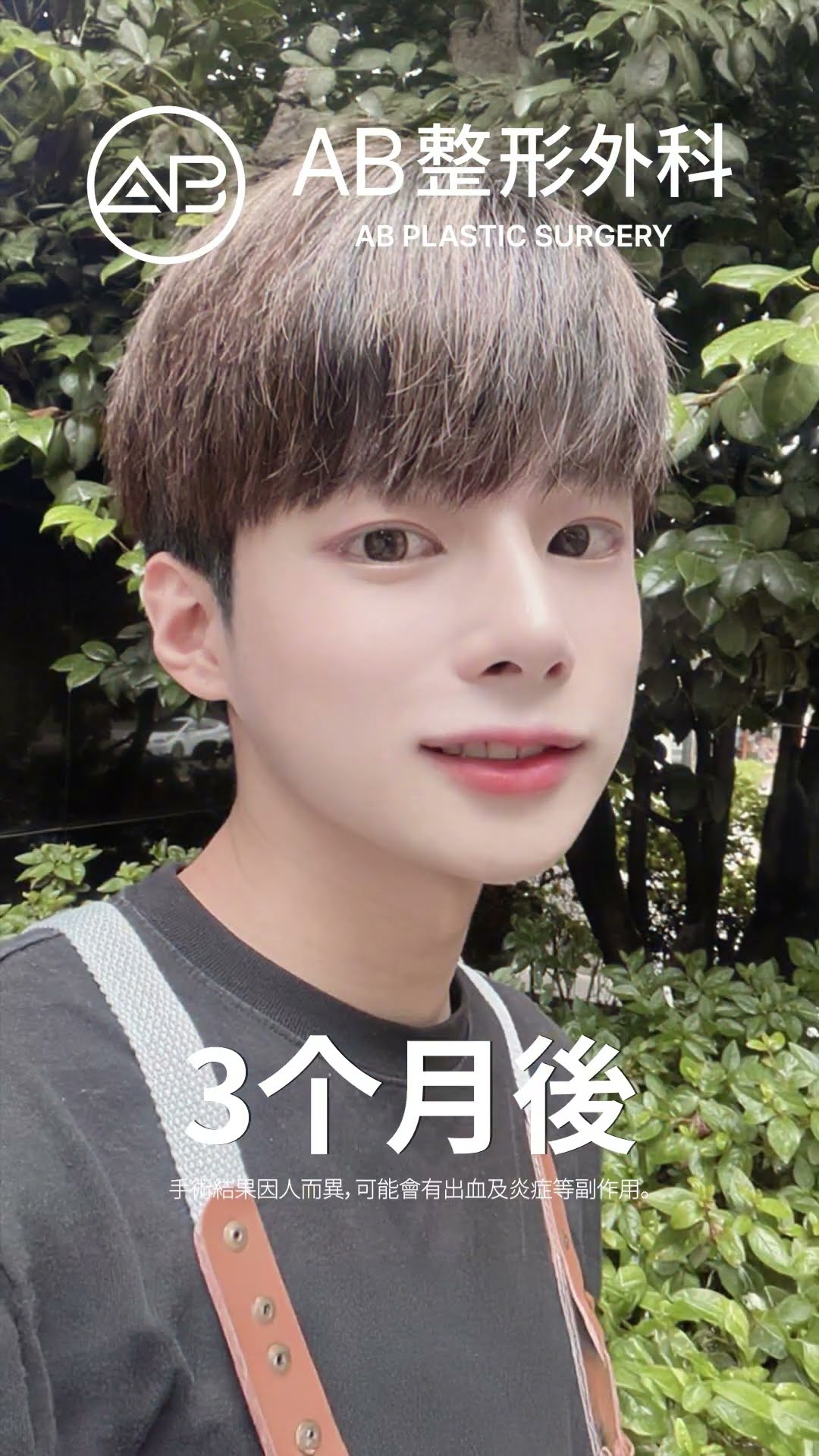 這是魔法嗎？手術後帥到不敢認！ #热门 #推荐