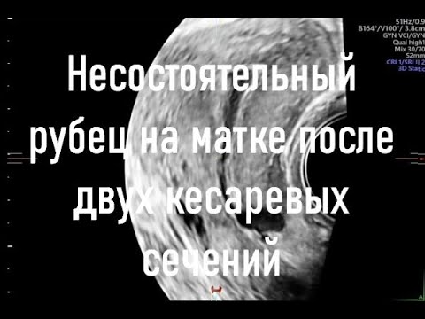 Несостоятельный рубец на матке после двух кесаревых сечений