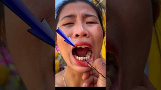 Torung ဟာသ: Tooth Extraction With Wire
