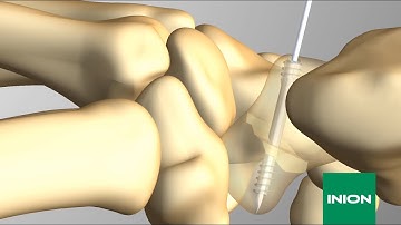 Scaphoid Fracture Fixation with Inion CompressOn™ Bioabsorbable Screw -  Surgical Technique