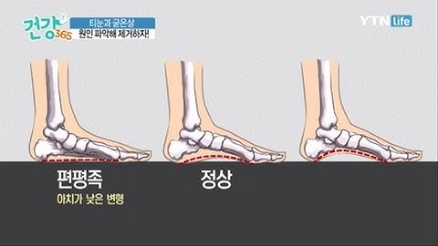 편평족과 요족, 무지외반증은 티눈과 굳은살 발생률을 높인다? / YTN 라이프