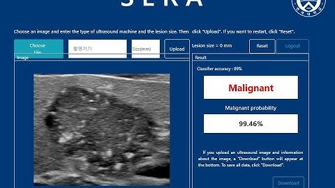 (ENG)Artificial intelligence for diagnosing a thyroid nodule