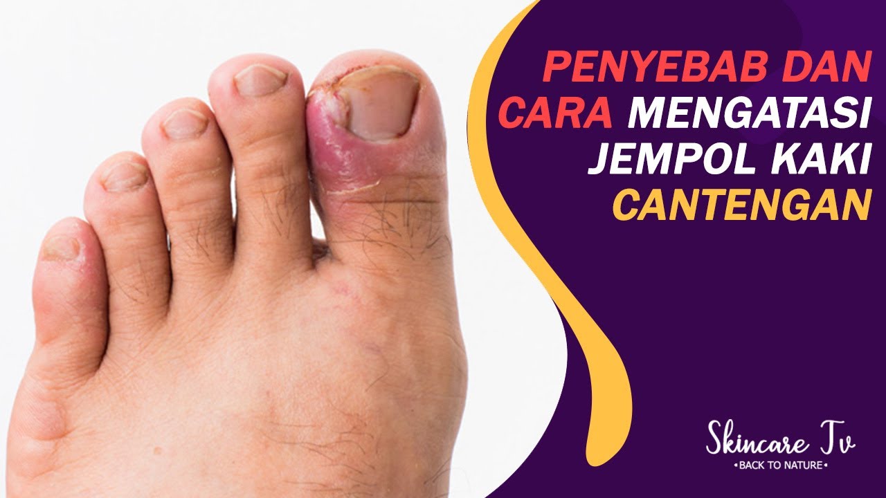Penyebab dan Cara Alami Mengatasi Cantengan Jempol Kaki