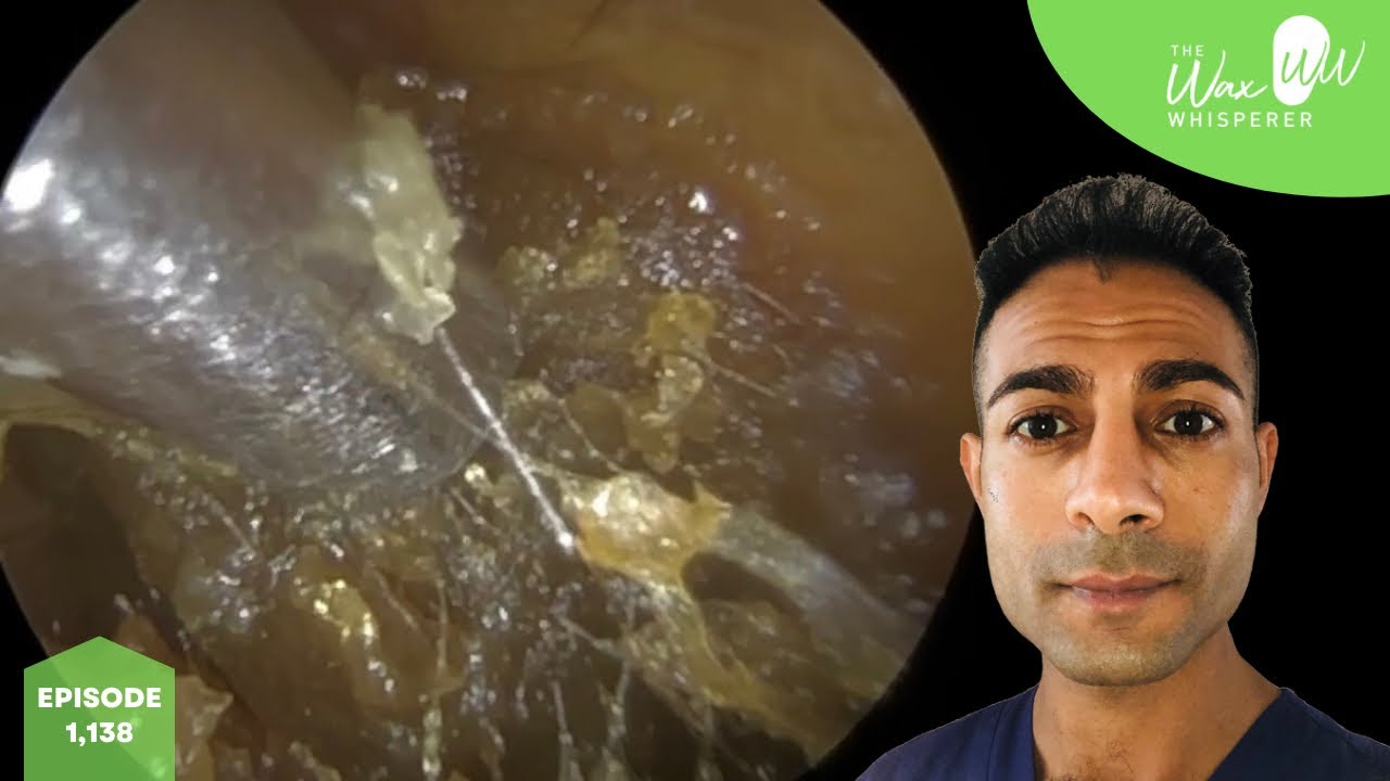 1,138 Completely Impacted Ear Wax Removal YouTube