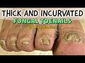 Thick and Incurvated Fungal Toenails: Trimming  and Treating Fungal Toenails