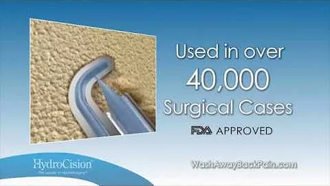 Hydrodiscectomy Patient Education for Minimally Invasive Treatment of Herniated Discs