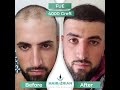 Hair transplant turkey hair of zrian fue 4000 graft