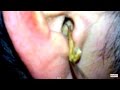 Dry earwax kotoran telinga 귀지 耳あか ที่แคะหู cerumen 耳垢 ушная сера