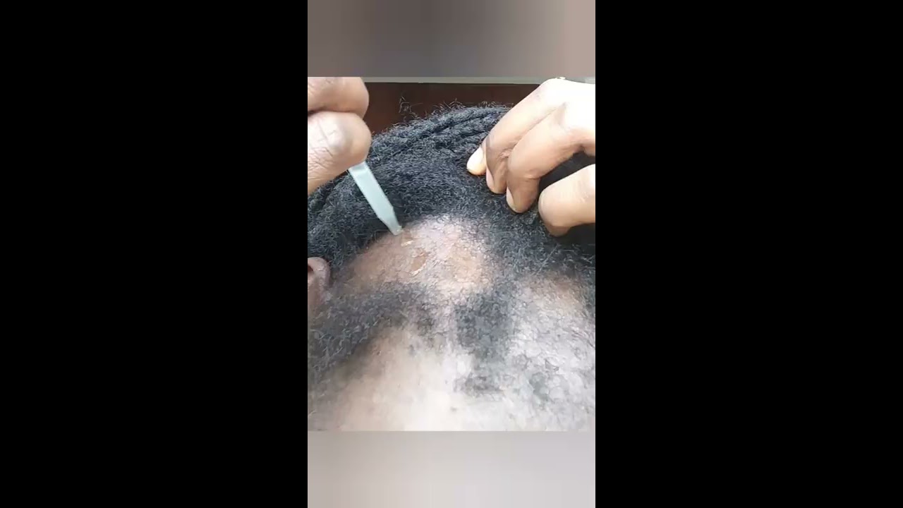 Will Onion Juice Growth My Baldness Day 1