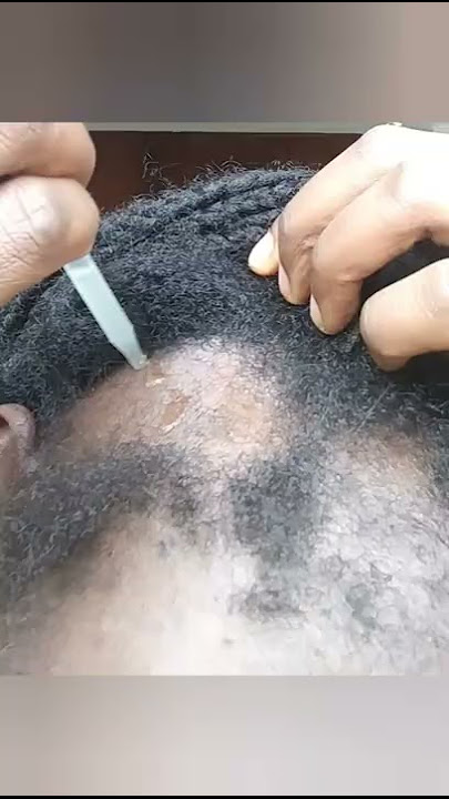 Will onion juice growth my baldness/ day 1