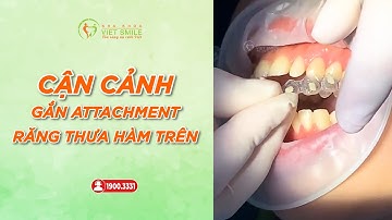 Gắn attachment bắt đầu hành trình niềng răng invisalign -KH Cao Kiều Oanh