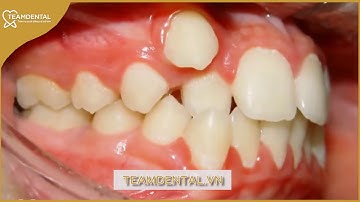 Cận cảnh quy trình niềng răng lệch lạc, khấp khểnh