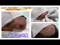 オデコの粉瘤　ブログでも粉瘤について詳しく解説してます。東京皮膚のできものと粉瘤クリニック　ふるばやし形成外科新宿院　大阪梅田形成外科クリニック