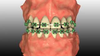 Malocclusion Type 2