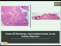 Endomyocardial Biopsy When How And What To See Dr Mukul Vij
