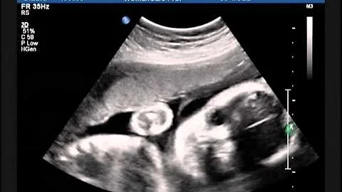 Baby Enzenbacher 30 week scan