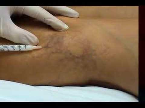 The Dermatology Center, UC Irvine, 949 824 0606. Foam sclerotherapy for leg veins. Unsightly leg veins are best removed with sclerotherapy in 95% of cases. Varicose veins are best removed with stab avulsion or CootTouch endovenous ablation (CTEV). Science and research at UCI. www.drzachary.net