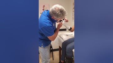 Thumb Spica Fiberglass Cast.., How to