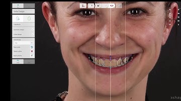 Công nghệ Smile Design - Thiết kế nụ cười kỹ thuật số - Biết trước kết quả| Nha khoa Thế Hệ Mới