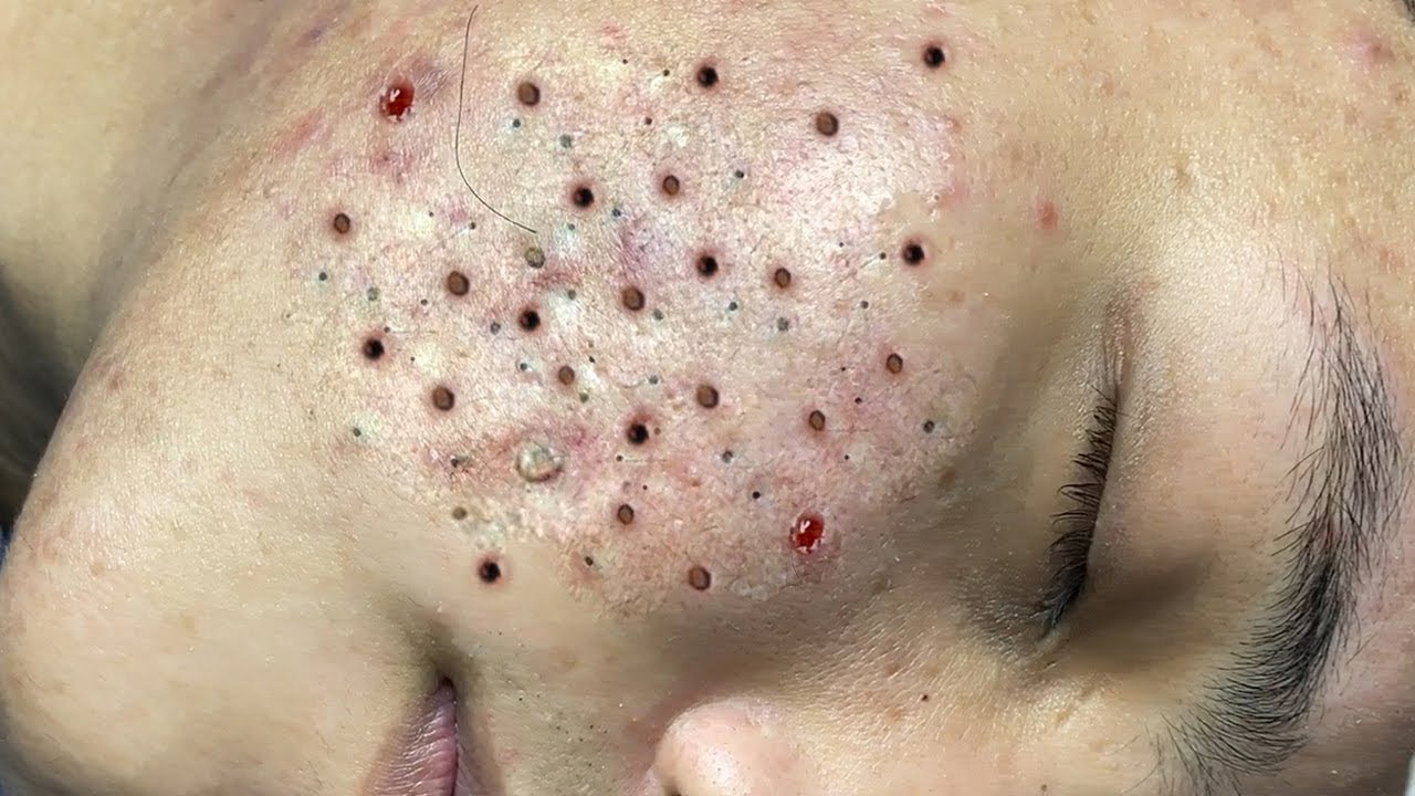 Make your Acne Treatment Acne spa 1164 Acne spa Treatment YouTube