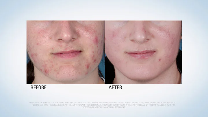 Acne Treatment with ZO Skin Health