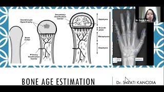Bone age estimation :Dr Swati Kanodia screenshot 4