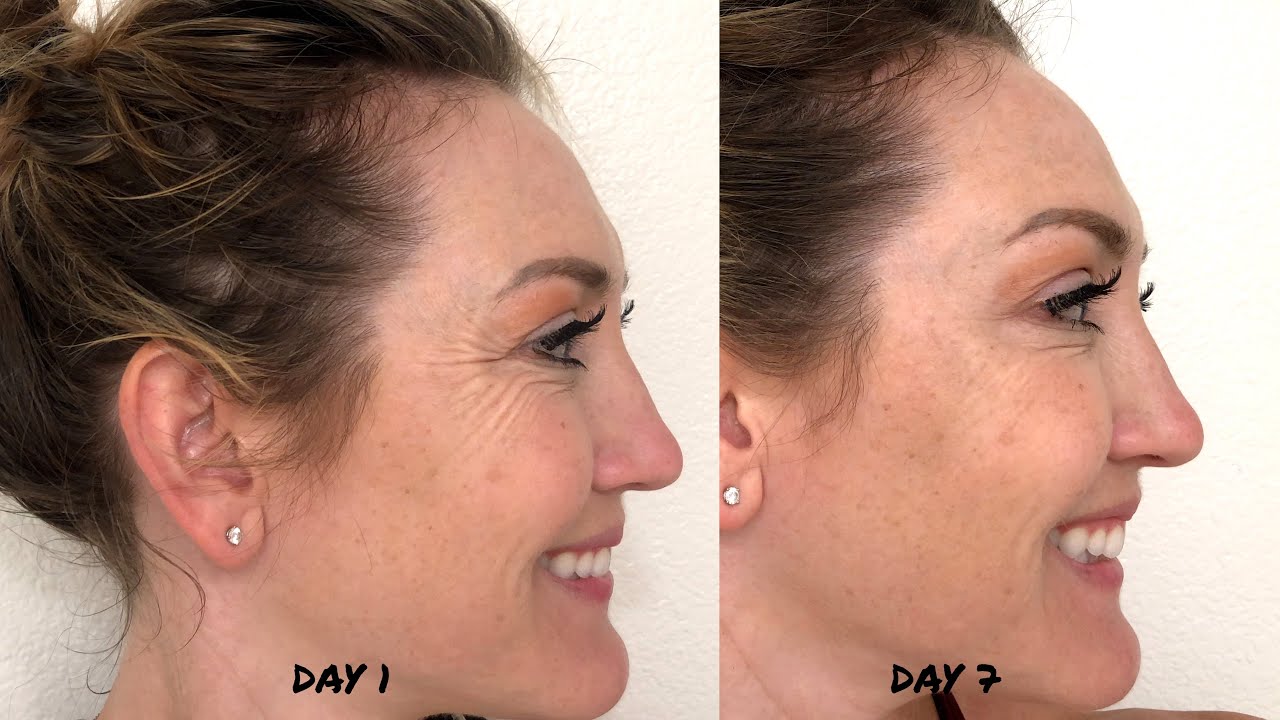 How Long Does It Take Botox To Work My Progress Shots YouTube