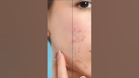 Photoshop trick || Realistic removes acne from the face
